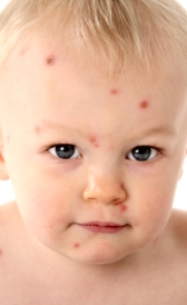 Chickenpox - KidsHealth